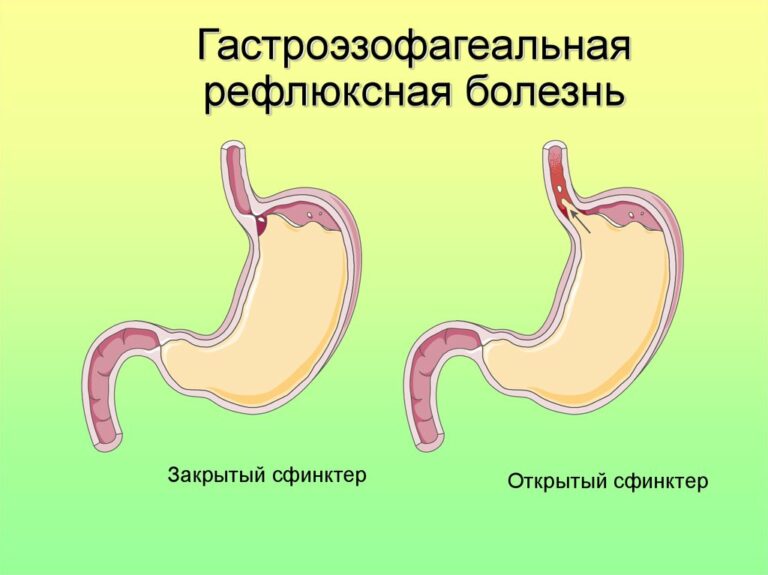 Гастрошунтирование желудка фото